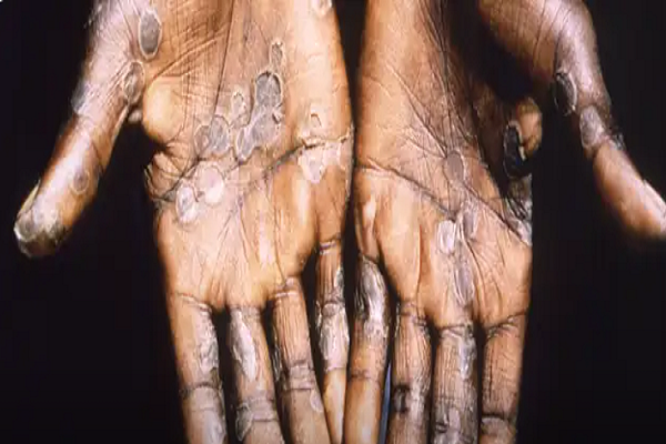 Possible first Dutch cases of monkeypox virus, rash not yet in